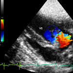 Image doppler cardiaque